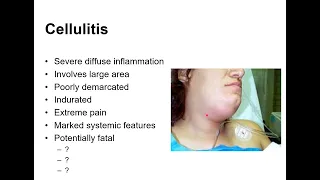 Spreading Orofacial Infections