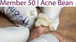 Acne Treatment Huong Da Nang# 051 | weekend | 2023