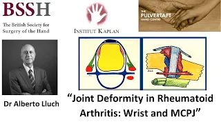 Joint deformity in rheumatoid arthritis  wrist and MCPJ 2nd Ed by Alberto Lluch