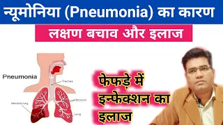 What Are Pneumonia Causes Symptoms and Treatment | न्यूमोनिया का इलाज