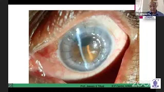 AIOS ARC - Cornea Update Series-Dr.Jeewan Titiyal