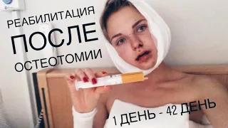 ПЕРВЫЕ ДНИ ПОСЛЕ ПЛАСТИЧЕСКОЙ ОПЕРАЦИИ | My Double Jaw Surgery Rehab