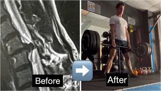 From Neck Herniated Disc to Deadlifting 100+kg - NO SURGERY