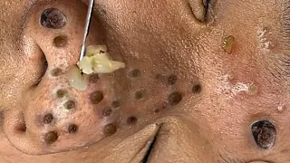 Blackhead Removal With Sac Dep Spa @11015