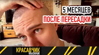 5 месяцев после пересадки волос  Красавчик