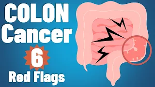 Colon cancer: 6 EARLY symptoms & why they occur | Colon cancer symptoms | colorectal cancer