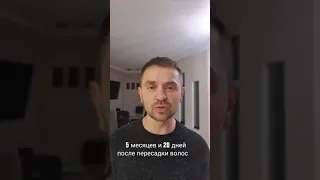 5 месяцев 20 дней после пересадки волос.