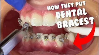 How they put braces - Dental Braces Tooth Time Family Dentistry New Braunfels