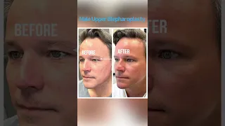 Male upper blepharoplasty