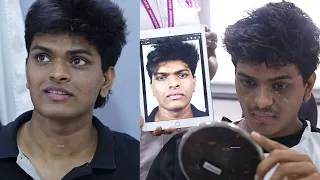 1 week Transformation in Rhinoplasty Surgery in India | Before and After Results