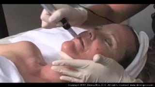 Dermapen Micro Needling Treatment Protocols 2013