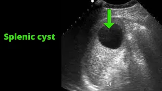 Splenic Cysts | Ultrasound Case