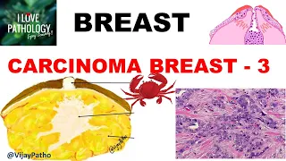 Diseases of Breast: Part 6: Breast carcinoma- Invasive:Types, Morphology,Prognosis & treatment