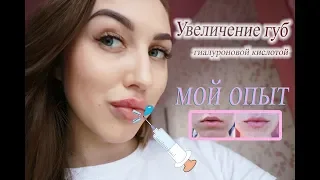 УВЕЛИЧЕНИЕ ГУБ ГИАЛУРОНОВОЙ КИСЛОТОЙ / До и после / Мой опыт