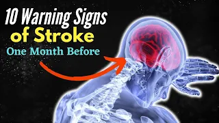 TOP 10 Warning Signs of Stroke One Month Before - Unbelievable Signs... Revealed!