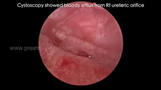 Post PCNL Bleeding