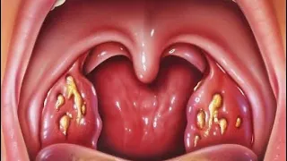 ADENOTONSILECTOMY PROCEDURE/REMOVAL OF TONSILS & ADENOIDS