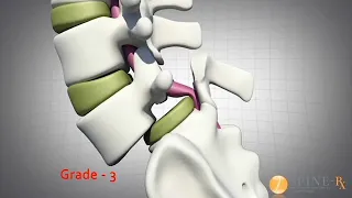 Spondylolisthesis