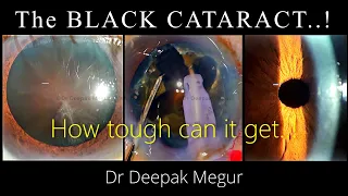 Phacoemulsification of a Black Cataract :  How tough it can be..? Dr Deepak Megur