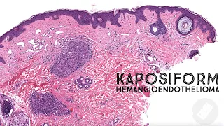 Kaposiform Hemangioendothelioma & Tufted Angioma (pathology dermpath dermatology dermatopathology)