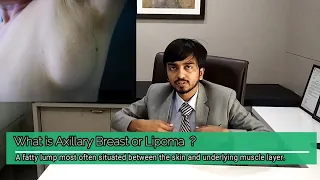 What is Axillary Breast or Lipoma Surgery explained by Plastic Surgeon Dr. Arth Shah