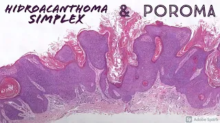 Poroma & Hidroacanthoma Simplex (dermatopathology dermatology pathology sweat gland tumors)