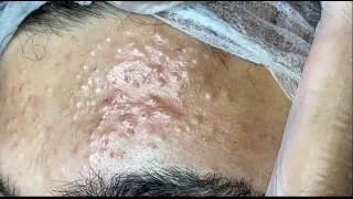 SUPER SATISFYING BLACKHEADS | VIDEO COMPLETE