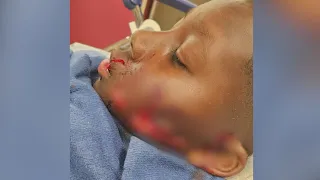 10-year-old boy recovering after dog attack in Kansas City