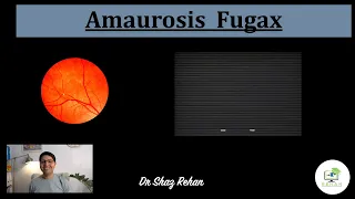 Amaurosis Fugax: What is it? What Causes it? Will I go Blind? How is it Treated? I Dr Rehan, 2021