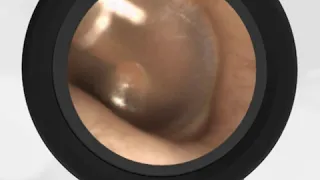 Valsalva ear popping video