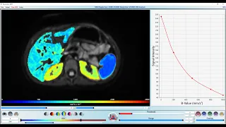 pMRI - How to Analyze Diffusion Weighted Images (DWI)