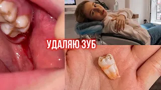 Удалила зуб мудрости 🦷 Больно или нет?? Как все прошло?