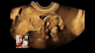 Acrania exencephaly anencephaly sequence fetal ultrasound by Dr.Haissam Aref, DMS,MSc,MD ultrasound