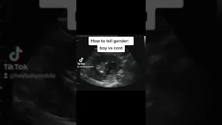 2D Ultrasound showing gender: Boy Parts vs Cord