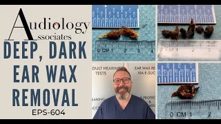 DEEP, DARK EAR WAX REMOVAL - EP604