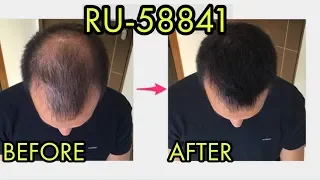 THE #1 REASON WHY I DON'T USE RU58841 FOR TREATING HAIR LOSS
