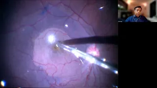 Lecture: Update on Macular Surgery