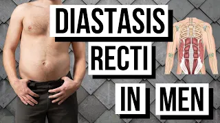 DIASTASIS RECTI IN MEN Over 35 (FIX YOUR BELLY BULGE!)