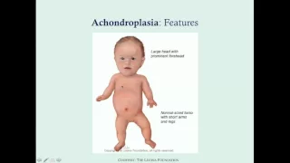 Achondroplasia - CRASH! Medical Review Series