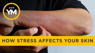 How stress affects your skin | Your Morning