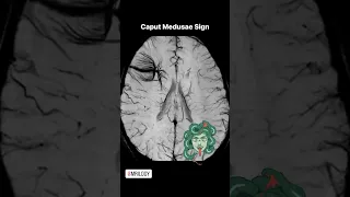 Caput Medusae sign -Developmental Venous Anomaly