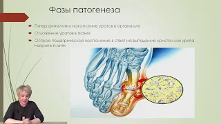 Наталья Шабанова.  Подагра: болезнь ли королей?