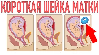 КОРОТКАЯ ШЕЙКА МАТКИ ВО ВРЕМЯ БЕРЕМЕННОСТИ | Короткая шейка матки что делать