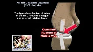 Medial Collateral Ligament Injuries - Everything You Need To Know - Dr. Nabil Ebraheim