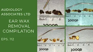 EAR WAX REMOVAL COMPILATION - EP 112