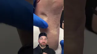 Painful BUMP on the Bottom of the Foot | Doctorly #shorts