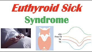 Euthyroid Sick Syndrome (Nonthyroidal Illness Syndrome) Causes, Symptoms, Diagnosis, Treatment