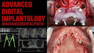 All on four (M4) / Trans-sinus / Jdental / Nova bone