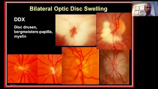 Approach to the Patient with Bilateral Optic Disc Swelling