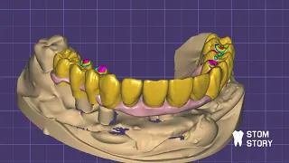 Изготовление балки с уступом ExoCad + B4D ( blender for dental)